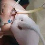 Root Canal Treatment