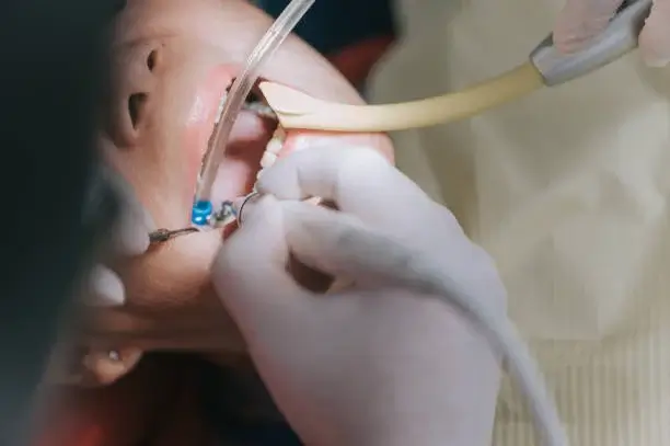 Root Canal Treatment