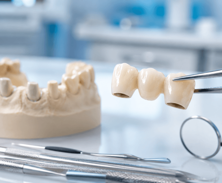 Can a dental bridge be repaired