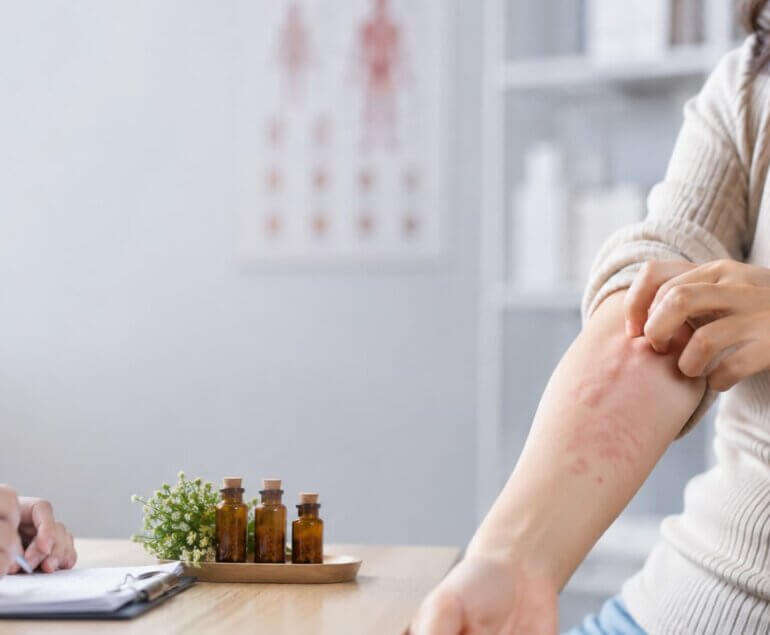 Homeopathy for Urticaria (Hives)