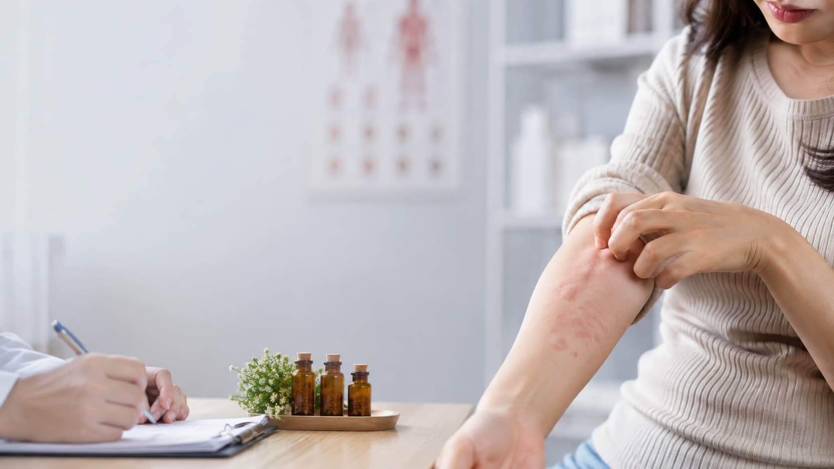 Homeopathy for Urticaria (Hives)