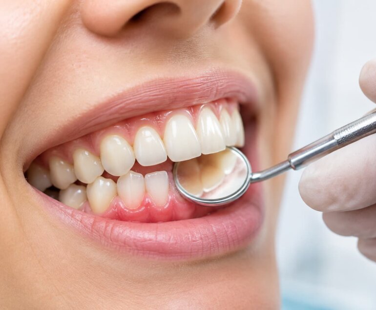 What is gingivitis
