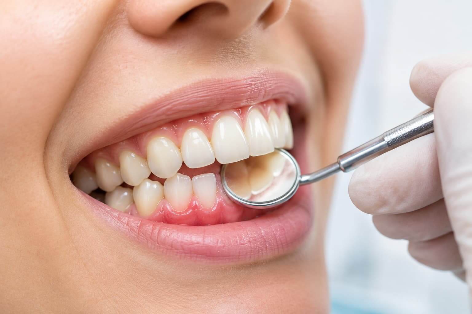 What is gingivitis