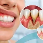 What Is Periodontitis?