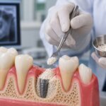 can dental bone graft cause cancer