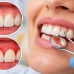 What Is Gingivitis?