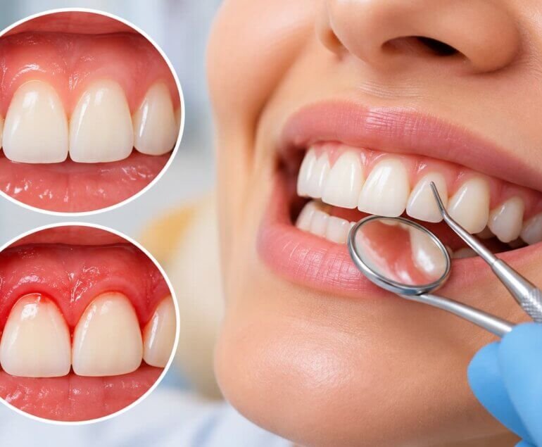What Is Gingivitis?